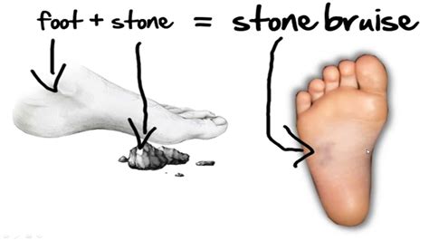 What is a Stone Bruise? Exploring the Mysteries of Foot Pain and Beyond